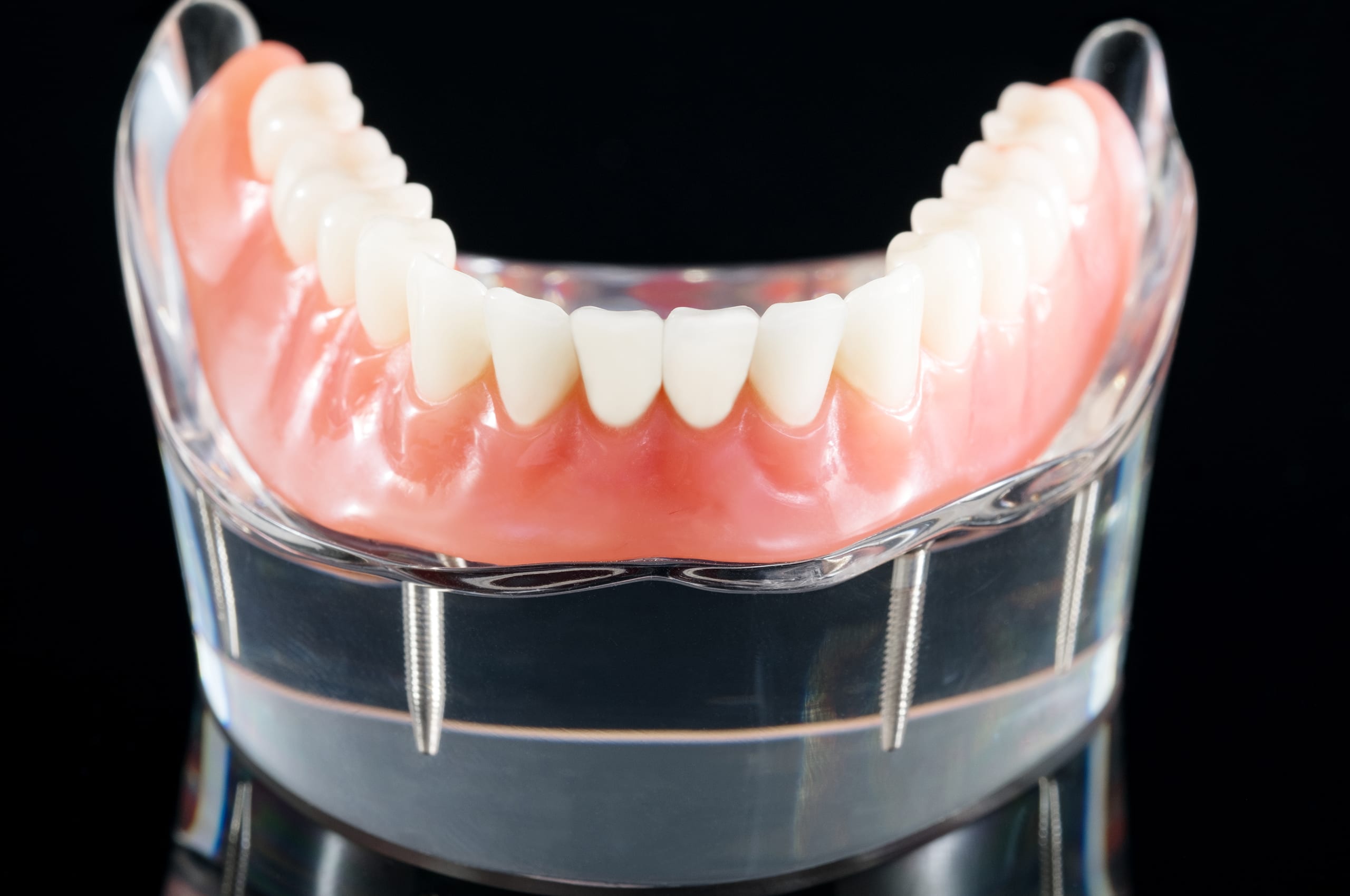 implant denture implant denture