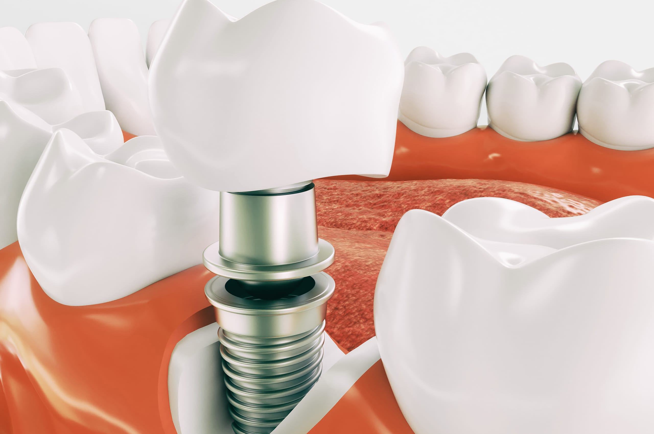 implant implant